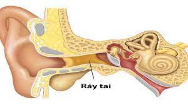 tắc nghẽn ráy tai